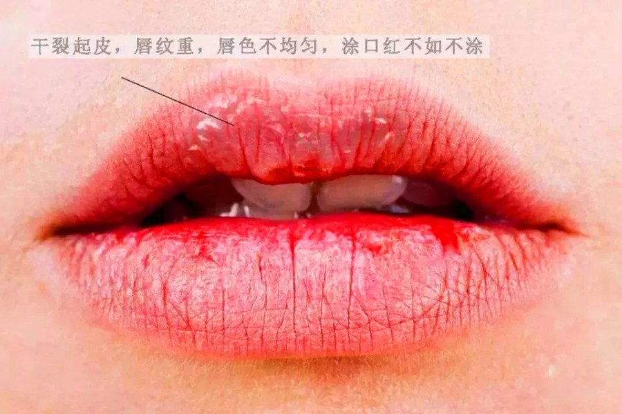广西皮肤管理培训机构：解决嘴唇干裂的急救方法