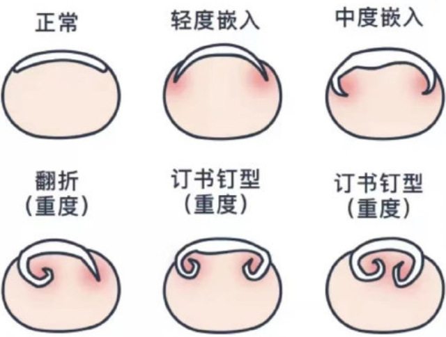 广西美甲基础培训：正确修剪指甲的方法